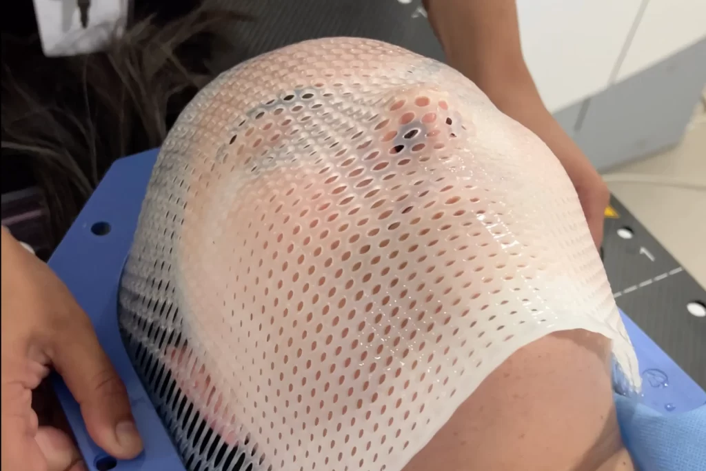 Máscara termoplástica para mantener la posición durante el tratamiento del cáncer de cabeza y cuello en Concepción