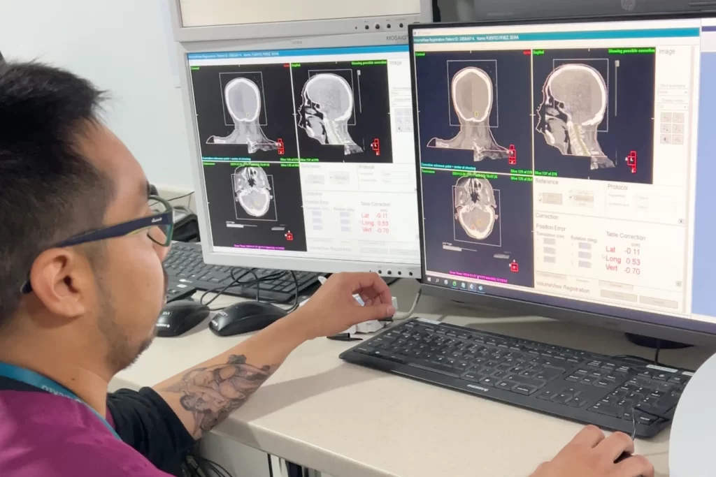 Planificación precisa del tratamiento del cáncer de cabeza y cuello en Concepción con software de dosimetría en ROS Clínica Oncológica