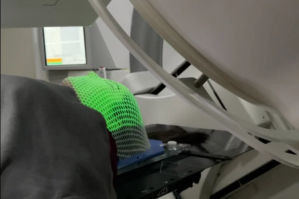 Aplicación de radioterapia para el cáncer de cabeza y cuello en Concepción con el acelerador Elekta Infinity