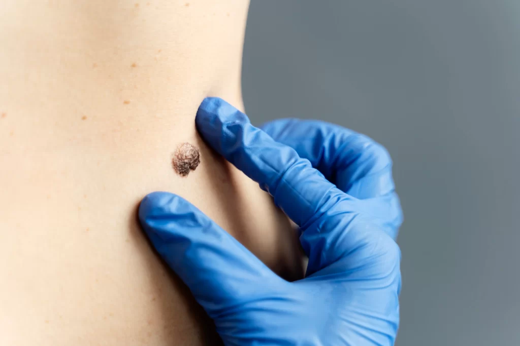 Profesional de salud evaluando una lesión cutánea sospechosa de cáncer de piel con guante de protección