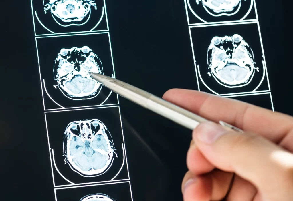 Imágenes cerebrales utilizadas para planificar radiocirugía estereotáctica SRS/SBRT.