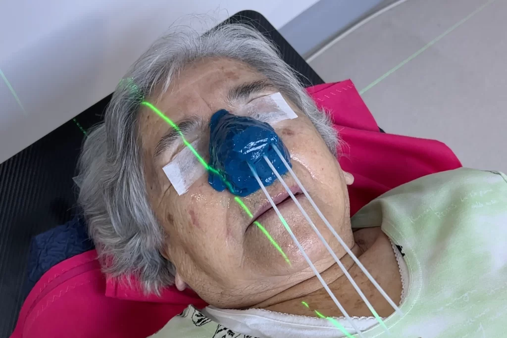 Aplicador de braquiterapia de piel en tratamiento para cáncer cutáneo en la nariz