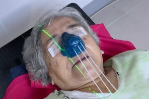 Aplicador de braquiterapia de piel en tratamiento para cáncer cutáneo en la nariz
