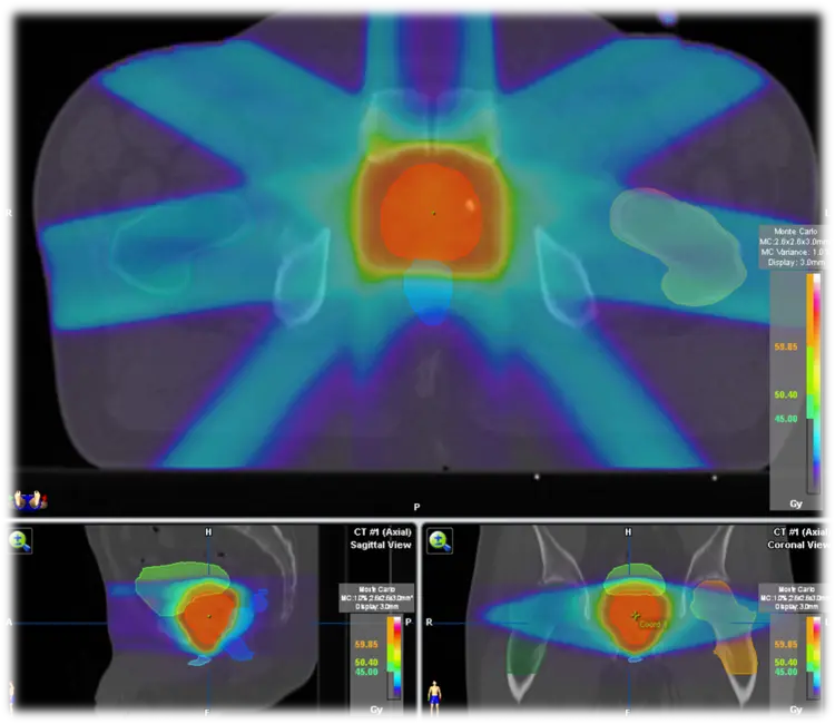 Imagen de distribución de dosis de radioterapia corporal estereotáctica (SBRT) utilizada para tratar el cáncer de próstata con alta precisión.