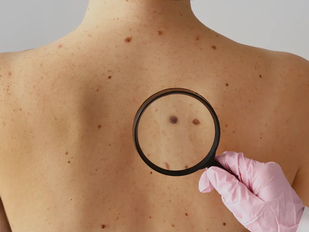 Evaluación de lunar sospechoso para detección precoz del cáncer de piel en control dermatológico