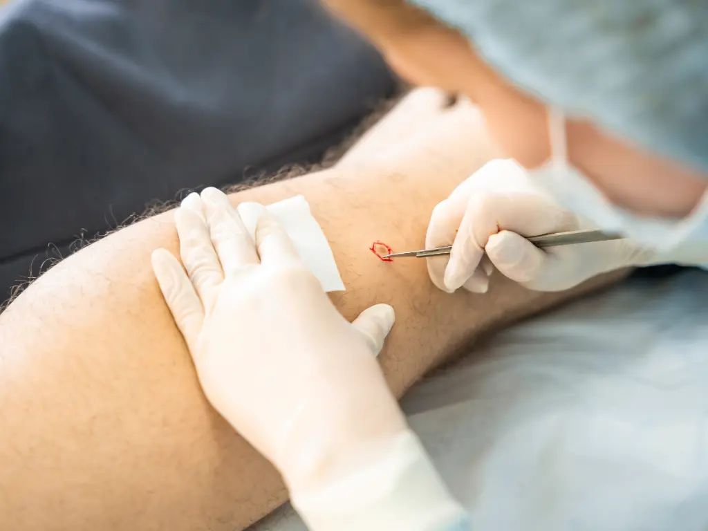 Procedimiento médico para diagnóstico y tratamiento temprano del cáncer de piel en paciente adulto